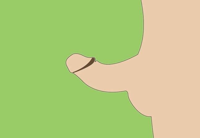 Η καμπυλότητα του πέους ως ένδειξη για χειρουργική διεύρυνση